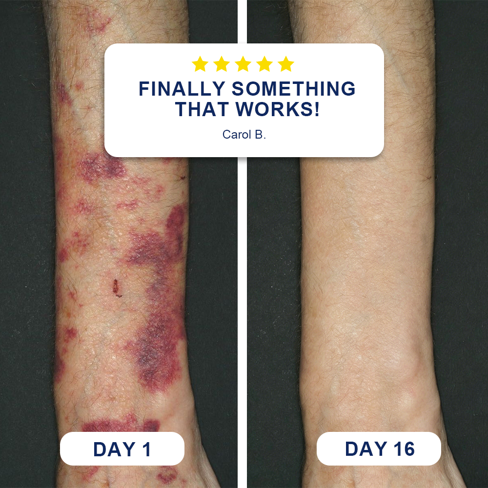 ✨Evolvion® Bruise Repair & Skin-Strengthening Cream❤️❤️❤️up