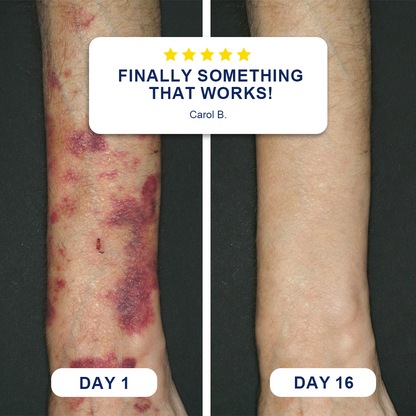 ✨Evolvion® Bruise Repair & Skin-Strengthening Cream❤️❤️❤️up