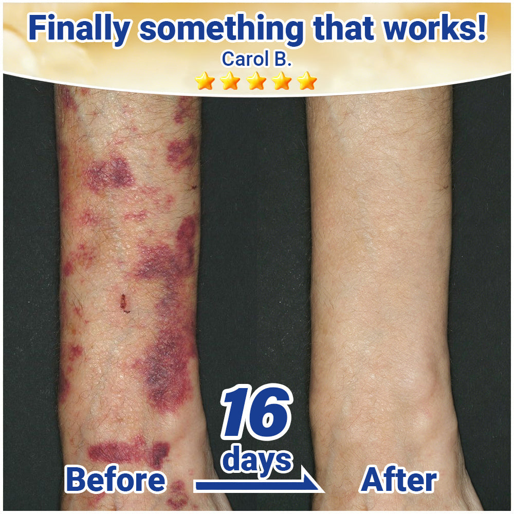 ✨Evolvion® Senile Purpura, Bruise & Fragile Skin Repair Cream🌿