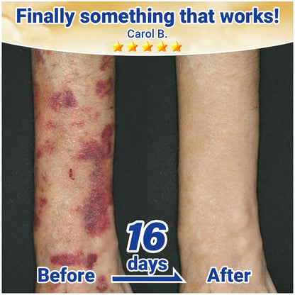 ✨Evolvion® Senile Purpura, Bruise & Fragile Skin Repair Cream🌻