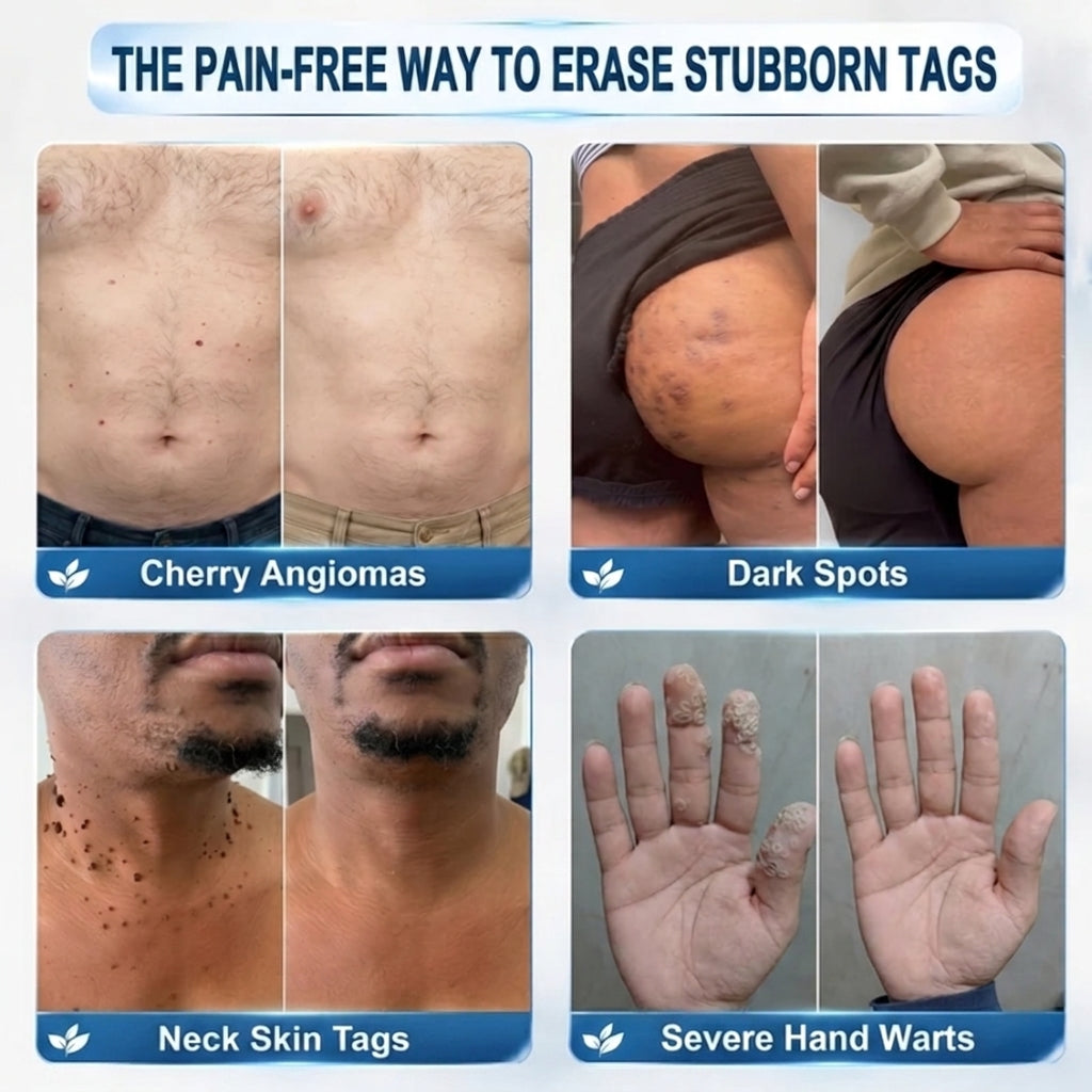 Evolvion® Precision Skin Tag Care Pen - BUY 2 GET 2 FREE: Family Value Pack